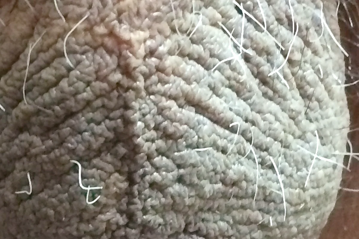 Healed scrotal incision site after penile implant placement using the Concealed-Scar Scrotal Technique, with the incision concealed in the natural scrotal fold.