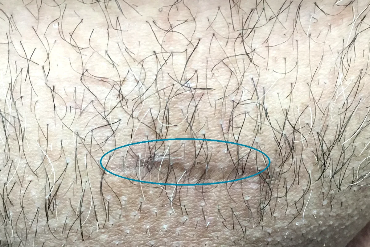 Healed transverse scar in the suprapubic region following infrapubic penile implant placement, circled for reference.